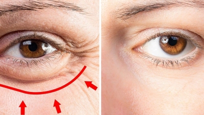Bác sĩ khuyến cáo cách làm giảm bọng mắt, tăng  thẩm mỹ cho phụ nữ