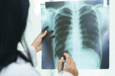 Tràn khí màng phổi là khí trong khoang màng phổi gây xẹp một phần hoặc toàn bộ phổi. Tràn khí màng phổi có thể xảy ra tự phát hoặc do chấn thương hoặc...